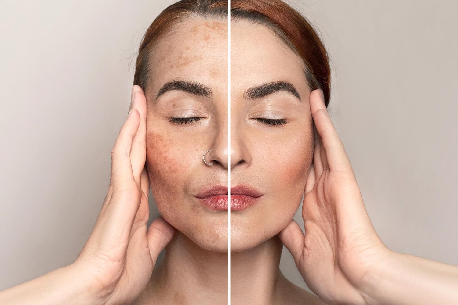 Pigmentation removal