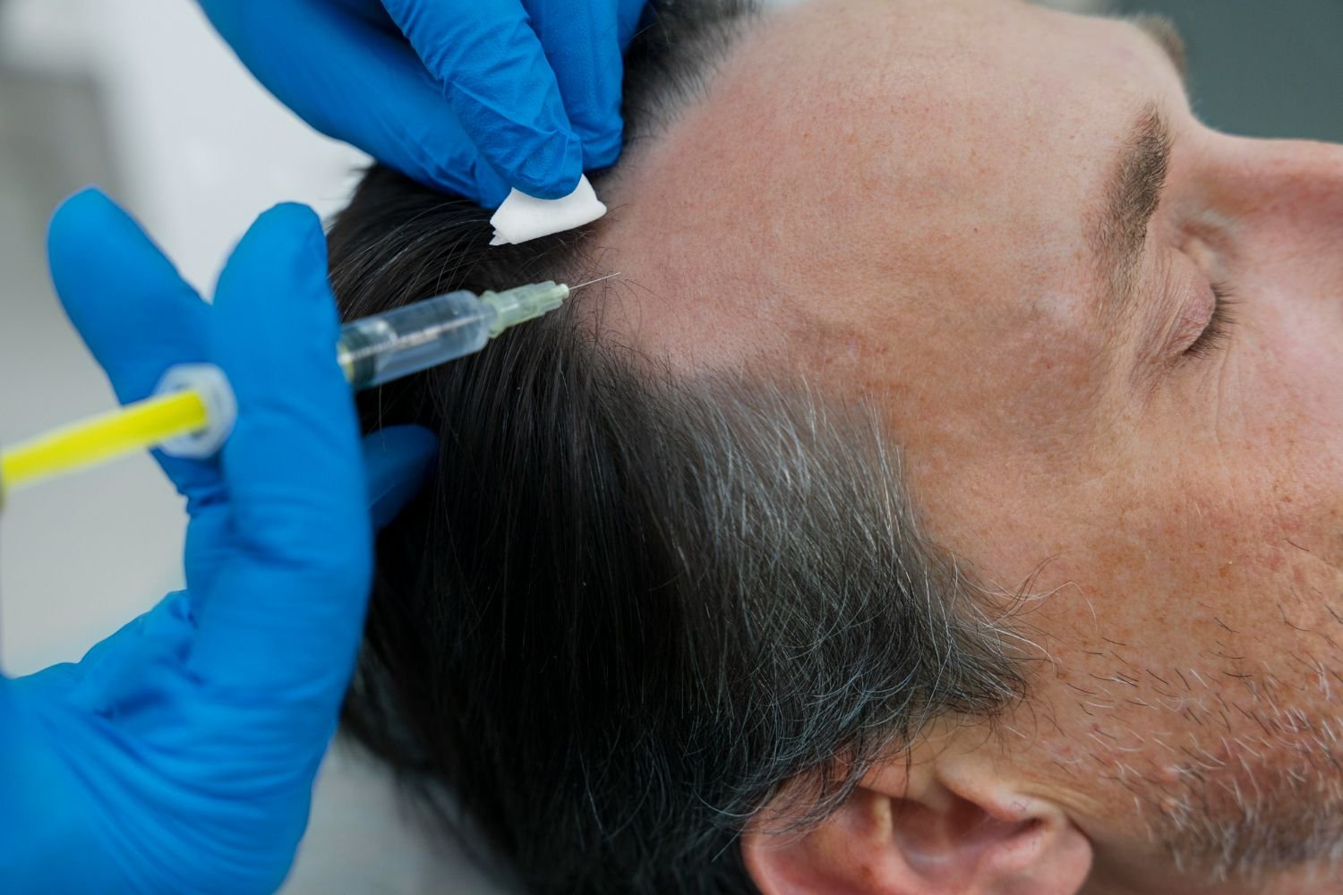 PRP Therapy